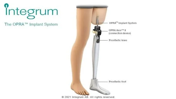 Diagram of the Integrum OPRA Implant System, showing the bone-anchored implant, connection device, and prosthetic components