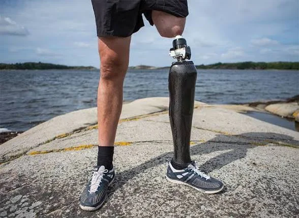 A patient with an osseointegrated prosthetic leg standing on rocks by the water